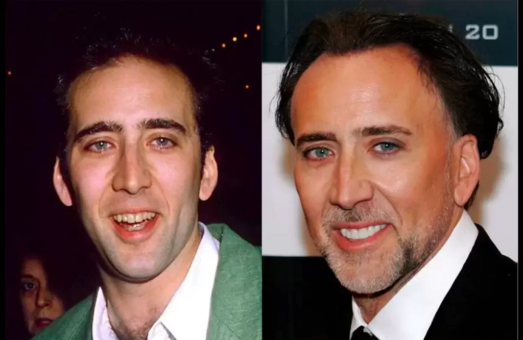 Dislerini-Yaptiran-Unluler-Nicolas-Cage