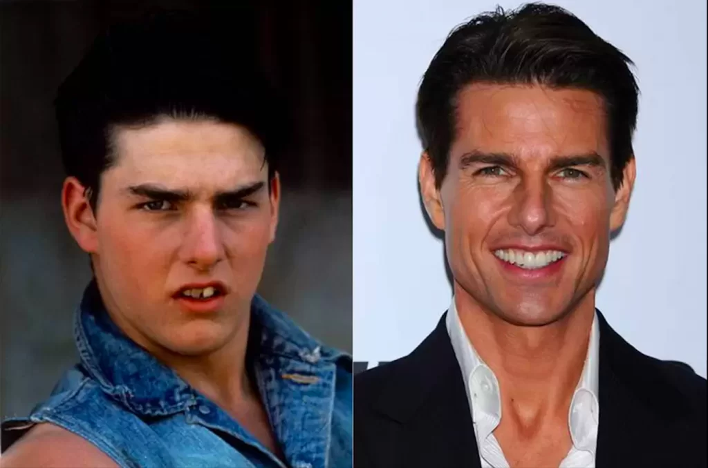 Dislerini-Yaptiran-Unluler-Tom-Cruise