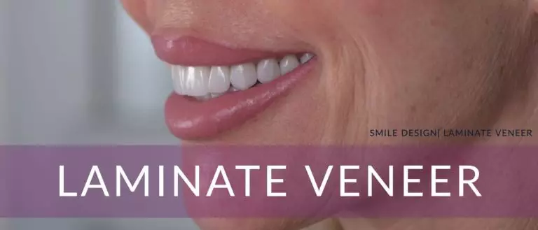 Nişantaşı Laminate Veneers Tedavisi