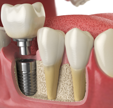 Single Tooth Dental Implant