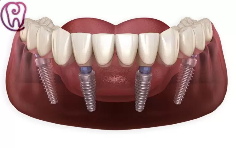 All On Four Implant