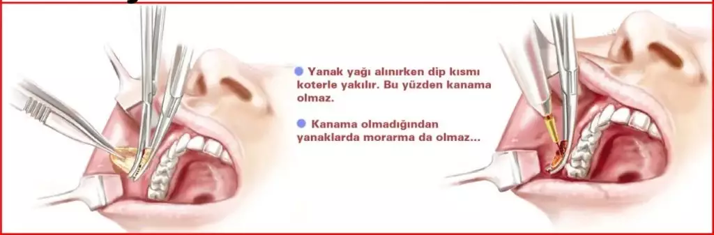 Bişektomi Fiyatları 2026