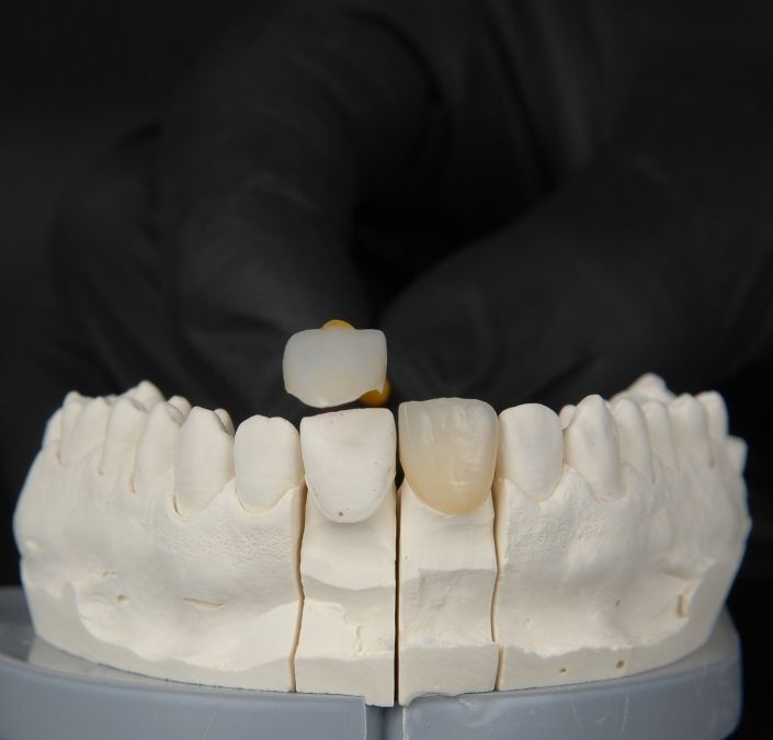 Lumineer Tooth Crowns