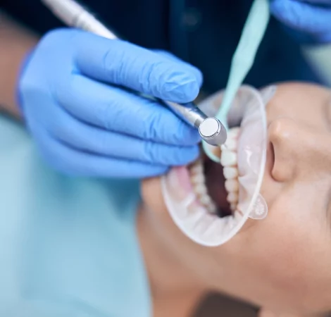 Dental Lamina tedavisi uygulanan bir kadının dişleri