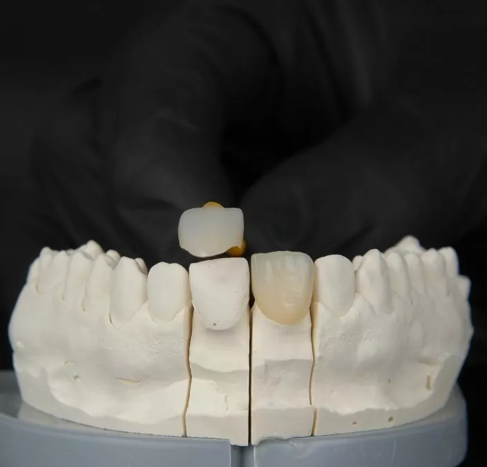 Lumineer Tooth Crowns